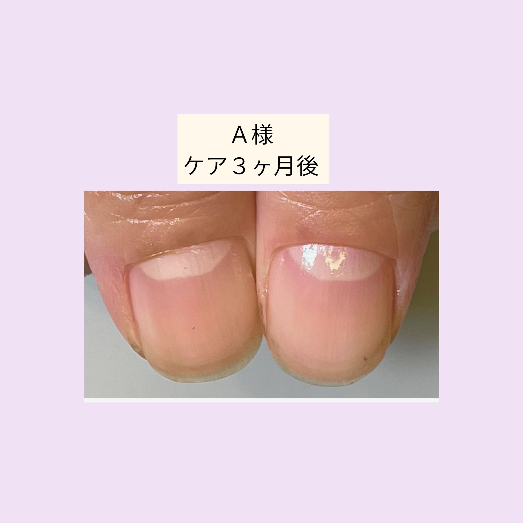 A様親指